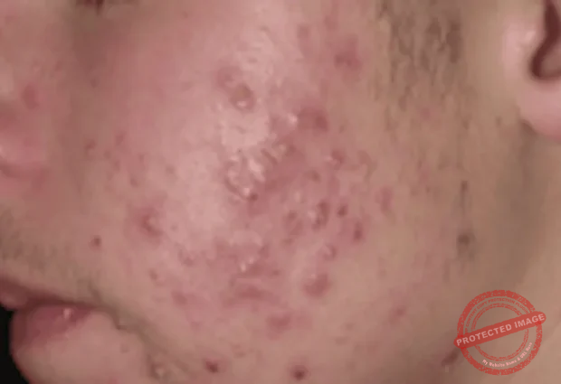 Severe Pimples are treated effectively with care at HomeopathyOne specialists.