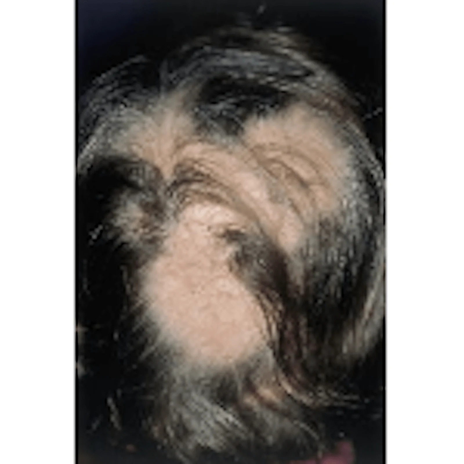 Alopecia Areata is treated effectively with Individualised homeopathic treatment at HomeopathyOne.